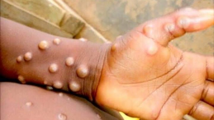 Viruela del mono se expande en el mundo: Estos países confirman casos de la monkeypox