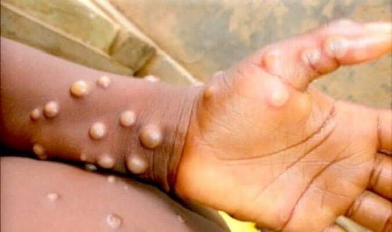 Estados Unidos analiza seis posibles casos de viruela del mono. Créditos: Internet