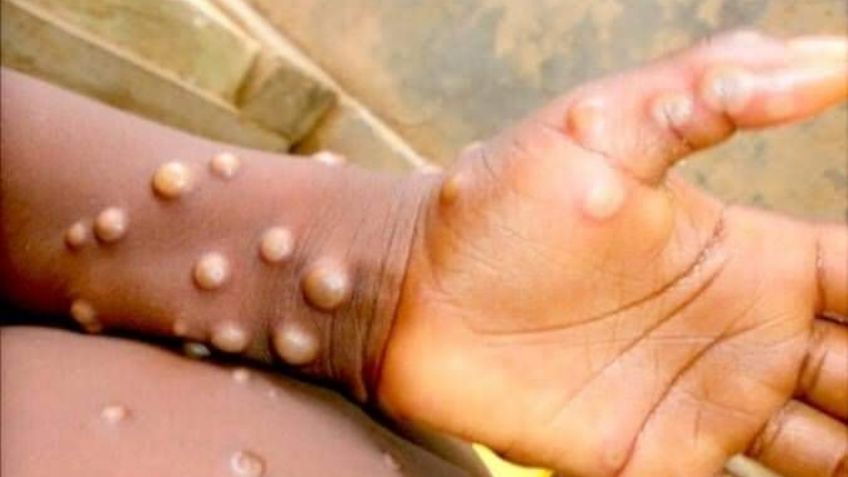 Viruela del mono se expande en el mundo: Estos países confirman casos de la monkeypox