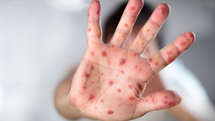 Alerta en Europa: Reino Unido teme que los casos de viruela de mono aún no llegan a su punto máximo