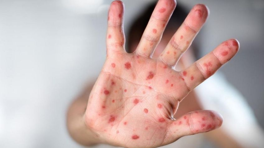 Alerta en Europa: Reino Unido teme que los casos de viruela de mono aún no llegan a su punto máximo