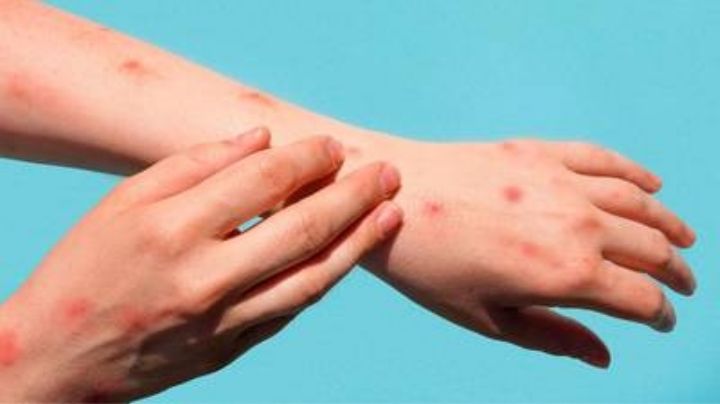 Una joven de 21 años: Detectan a posible contagiada de viruela del mono en norte de México