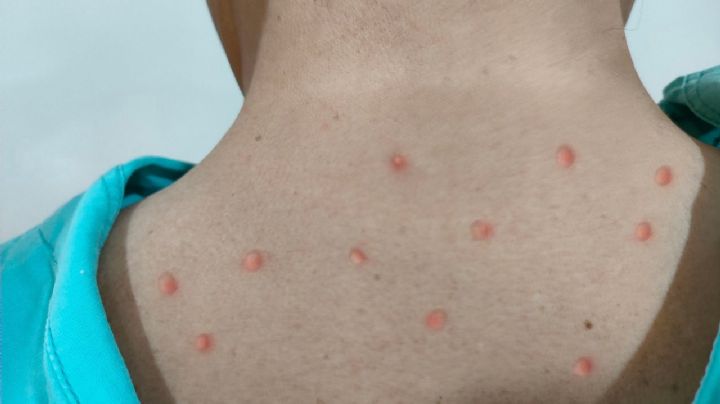 Salud Sonora llama a recibir atención médica ante síntomas por viruela del mono