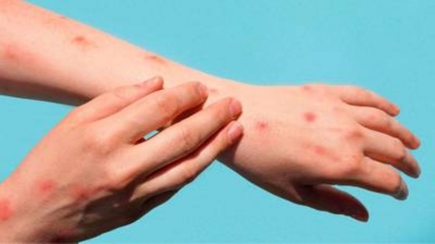 Una joven de 21 años: Detectan a posible contagiada de viruela del mono en norte de México