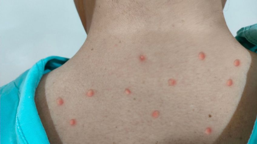 Salud Sonora llama a recibir atención médica ante síntomas por viruela del mono