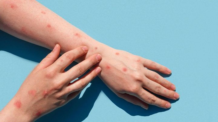 Expertos descubrirían por qué la viruela de mono se extiende velozmente alrededor del mundo