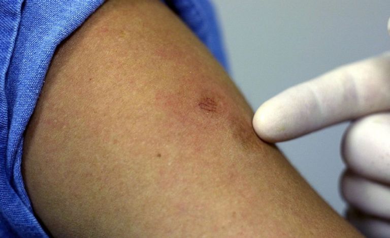 Expertos descubren por qué la viruela del mono se habría expandido tan rápido