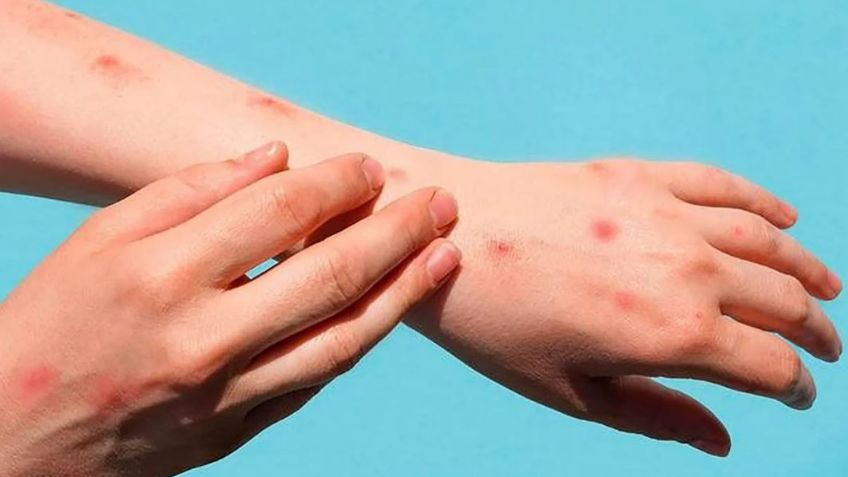 La viruela de mono se extiende en Europa: Reino Unido reporta más de 300 casos del virus