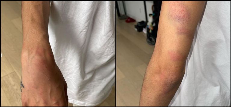 Heridas de Mychelle Johnson