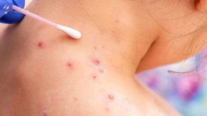Alerta en EU: Detectan a dos menores con viruela del mono; investigan las causas del contagio