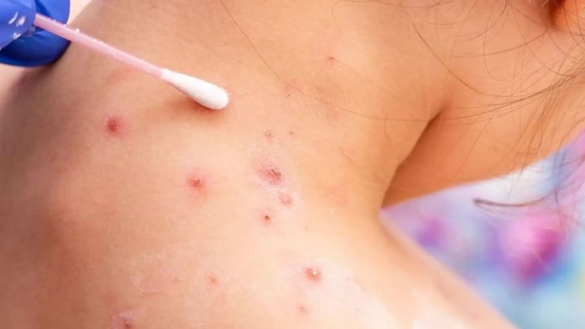 Alerta en EU: Detectan a dos menores con viruela del mono; investigan las causas del contagio