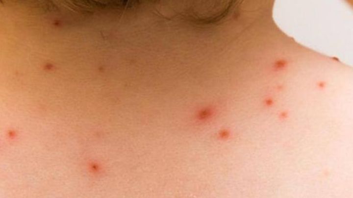 FOTOS: Polémico actor se contagia de viruela del mono; "No le deseo esto ni a mi peor enemigo", dice