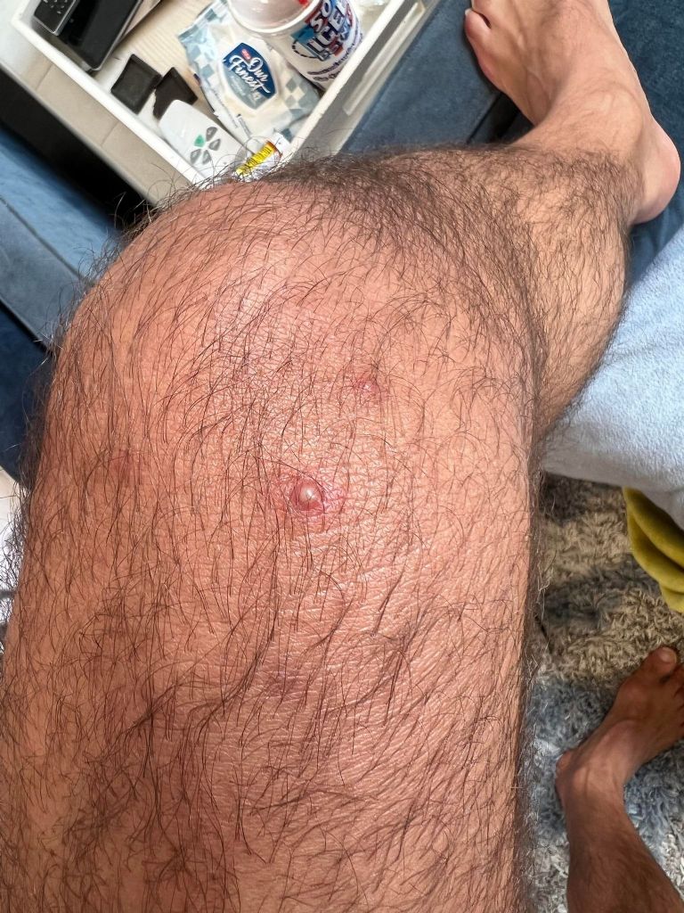 El actor Silver Steele compartió su experiencia tras contraer la viruela del mono. Foto: Twitter