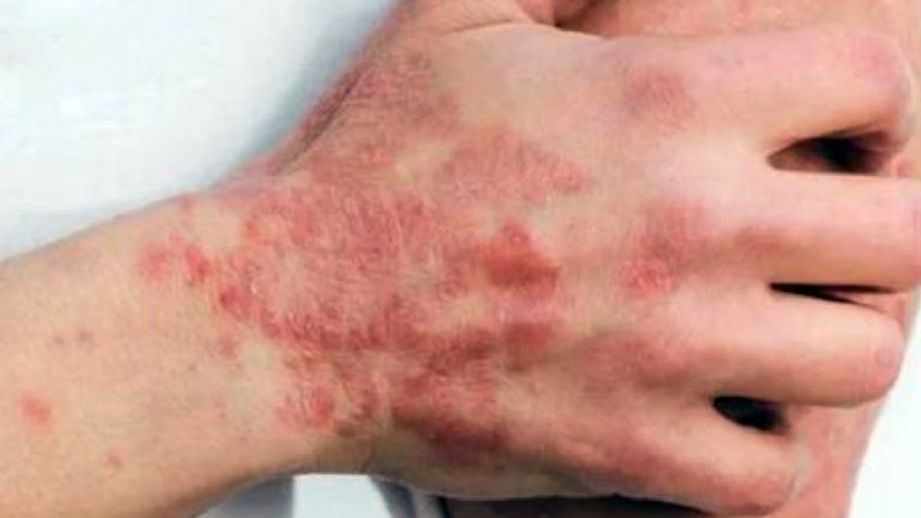 Jurisdicción Sanitaria aconseja medidas para evitar la viruela del mono en Sonora