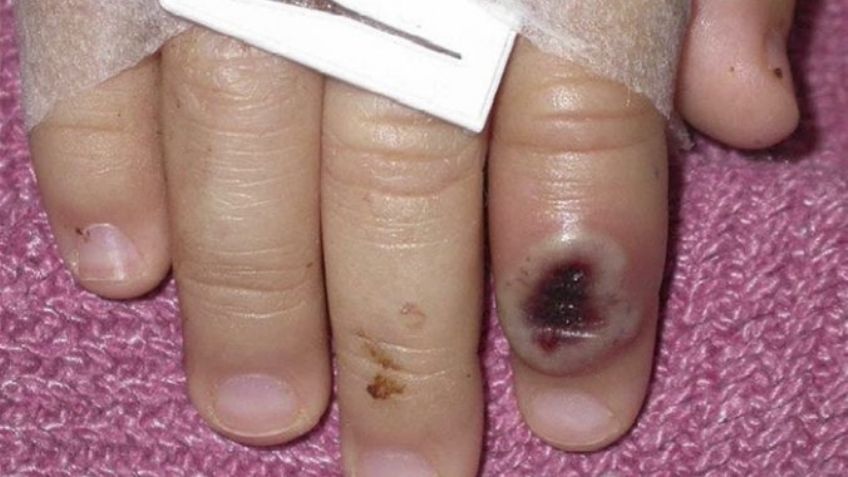 Viruela del mono se expande en México: Michoacán detecta su primer caso; proviene de la CDMX