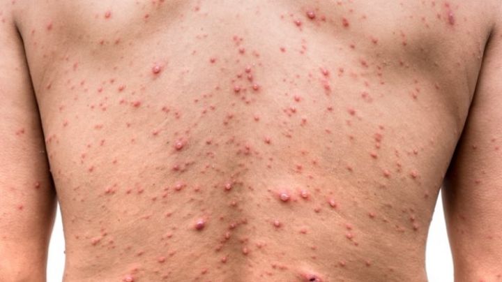 Buenas noticias: OMS reporta descenso en contagios de viruela del mono en varios países