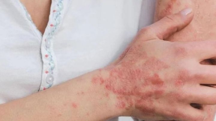 Viruela del mono en México se mantiene al alza: Hay 504 casos, la mayoría en CDMX