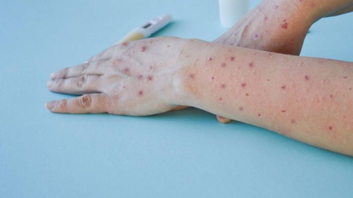 Reino Unido reporta más de 2 mil 800 casos por viruela del mono; el virus estaría en toda la región