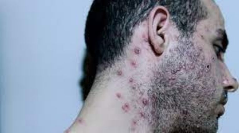 En el mundo hay más de 19 mil casos de viruela del mono