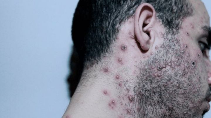 51 casos de Viruela Símica en el Estado de México; Es la tercera entidad con más contagios