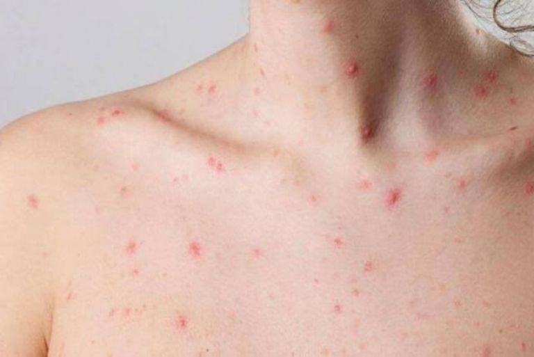 Caso de Viruela Símica