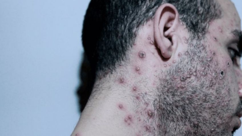 51 casos de Viruela Símica en el Estado de México; Es la tercera entidad con más contagios