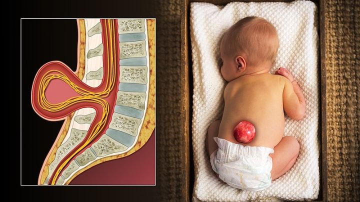 Día Internacional de la Espina Bífida: ¿Por qué se conmemora el 21 de noviembre? Origen