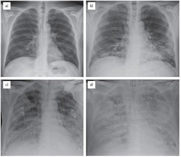 "síndrome del pulmón blanco"