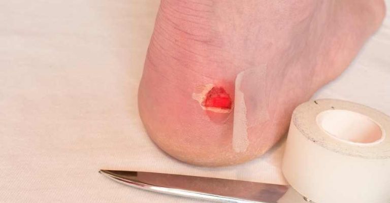 Las ampollas pueden ser realmente dolorosas, evítalas con este tip