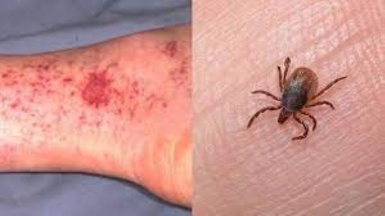 Mueren 44 por rickettsia en Sonora. Foto: Twitter