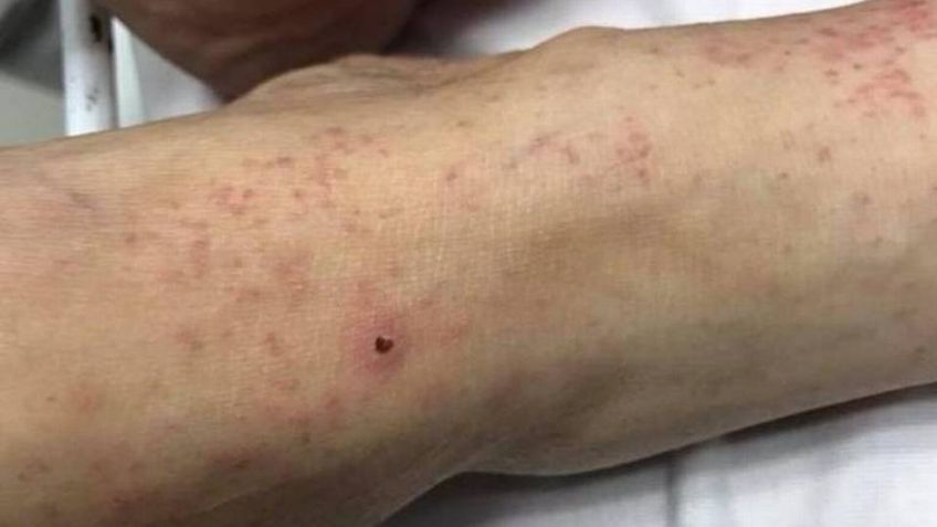 Alerta en Sonora: Suman 44 muertes por rickettsia en lo que va del 2023