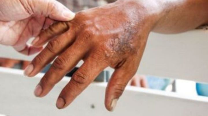 Día Mundial contra la Lepra 2024: ¿Por qué se conmemora este domingo 28 de enero?