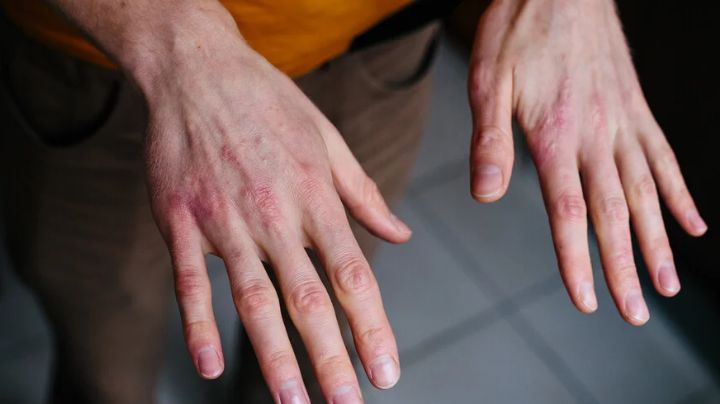 Quemadura por frío: ¿Cómo prevenirlas y qué hacer si las sufres?