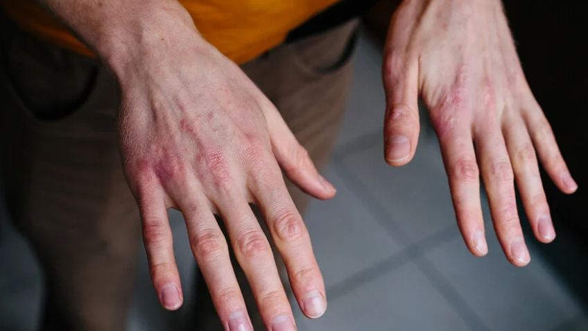 Quemadura por frío: ¿Cómo prevenirlas y qué hacer si las sufres?