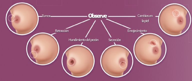 Claves para una autoexploración de las mamas efectiva. Foto: Secretaría de Salud