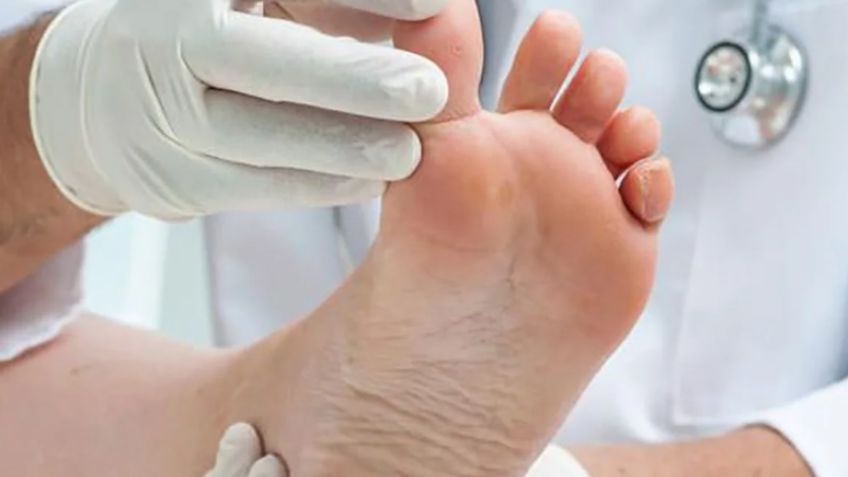 Remedios caseros para el pie de atleta; alivia la comezón y el mal olor