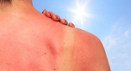 Secretaría de Salud emite advertencia por rayos UV; así puedes evitar el cáncer