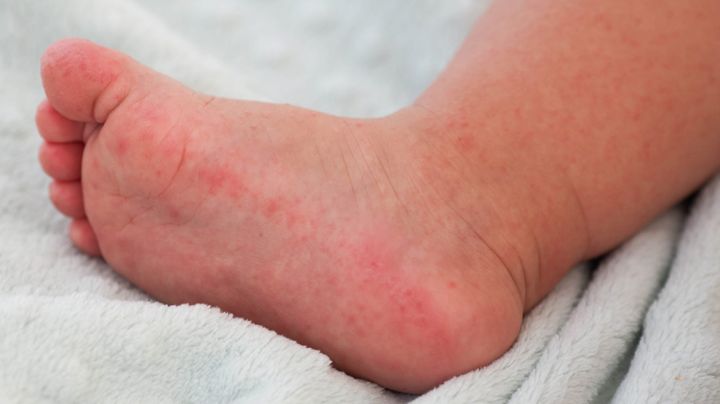 Se encienden alarmas en Hidalgo; reportan 7 casos activos de virus coxsackie