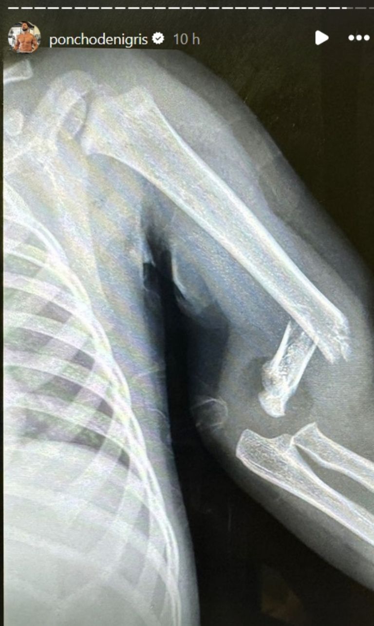 Hijo de Poncho De Nigris sufre fractura en el brazo