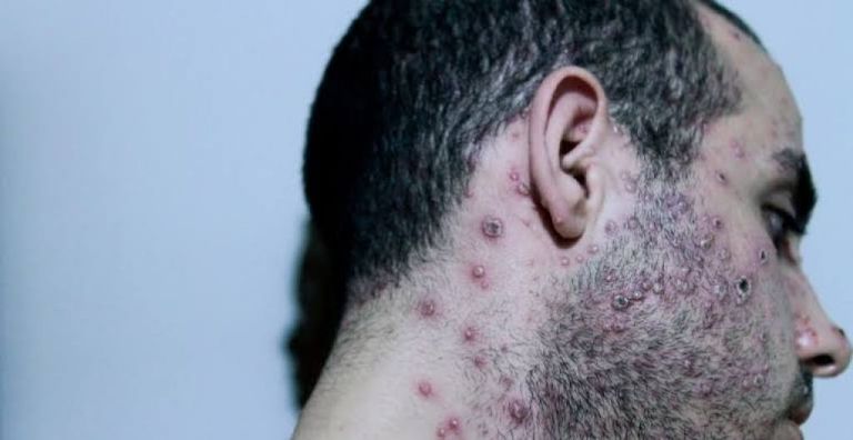 Así luce una persona con viruela del mono