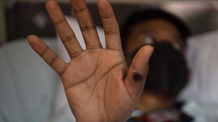 ¿Cómo se contagia? Estas son las vías de transmisión de la viruela del mono