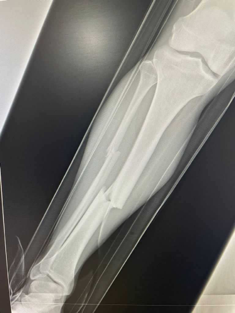 Fractura del Hobbit Bermúdez