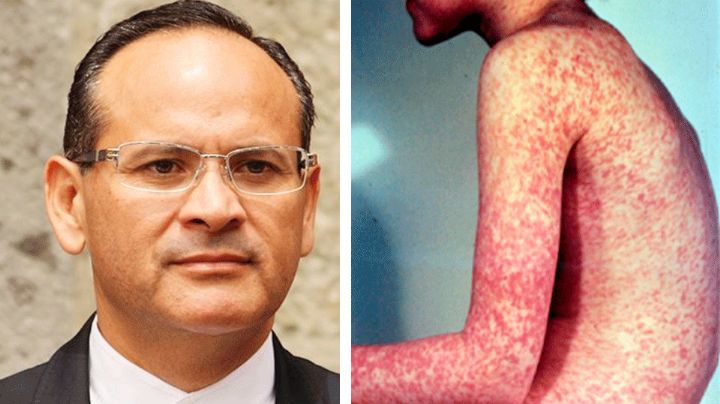 Reportan 43 casos de sarampión en Jalisco; la mayoría en menores y en diversos municipios