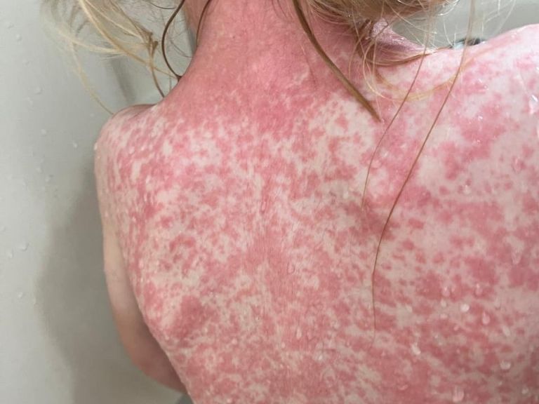 Los pequeños son los más afectados 