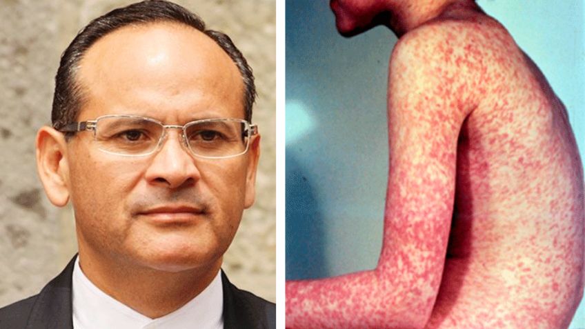 Reportan 43 casos de sarampión en Jalisco; la mayoría en menores y en diversos municipios