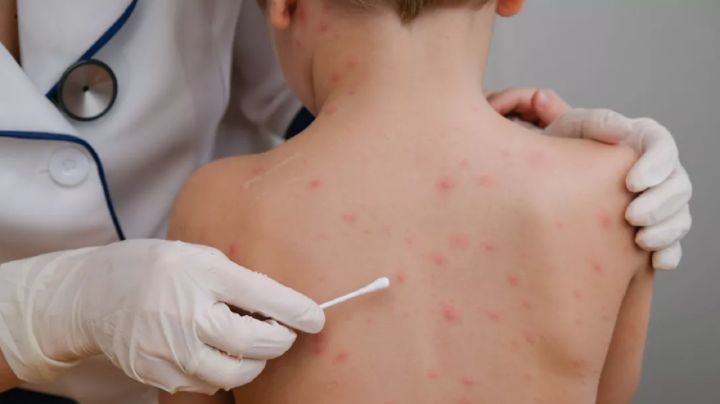 México enfrenta 23 muertes por sarampión pese al reciente descenso en la curva de contagios