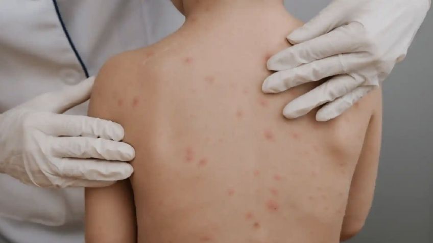 ALERTA en secundaria de Hermosillo por casos de varicela: ¿Qué recomienda Salud Sonora?