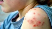 Foto ilustrativa de la nota titulada Se disparan contagios de sarampión en México: Síntomas y cómo conseguir la vacuna
