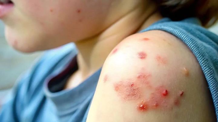 Se disparan contagios de sarampión en México: Síntomas y cómo conseguir la vacuna