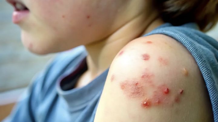 ¡Alerta! México registra 362 casos de sarampión; Chihuahua concentra la mayoría